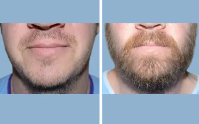 Before and After